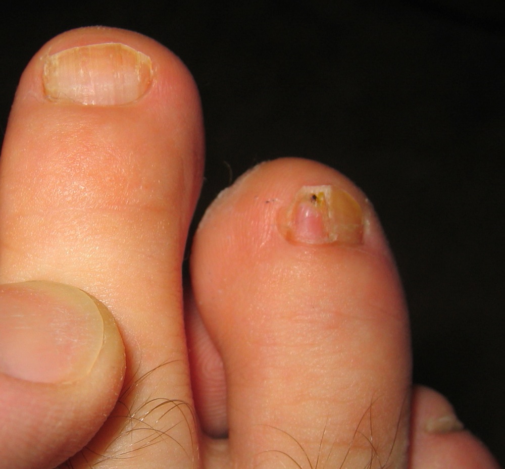 Infections Caused By Common Fungus Clear Toes Clinic