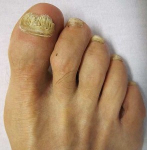 Why Our Toenails Thicken As We Age