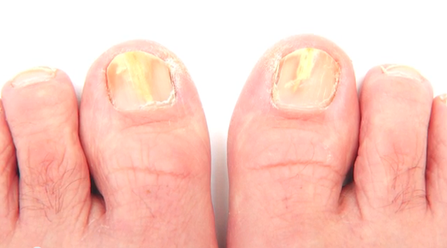 What Happens If Toenail Fungus Goes Untreated