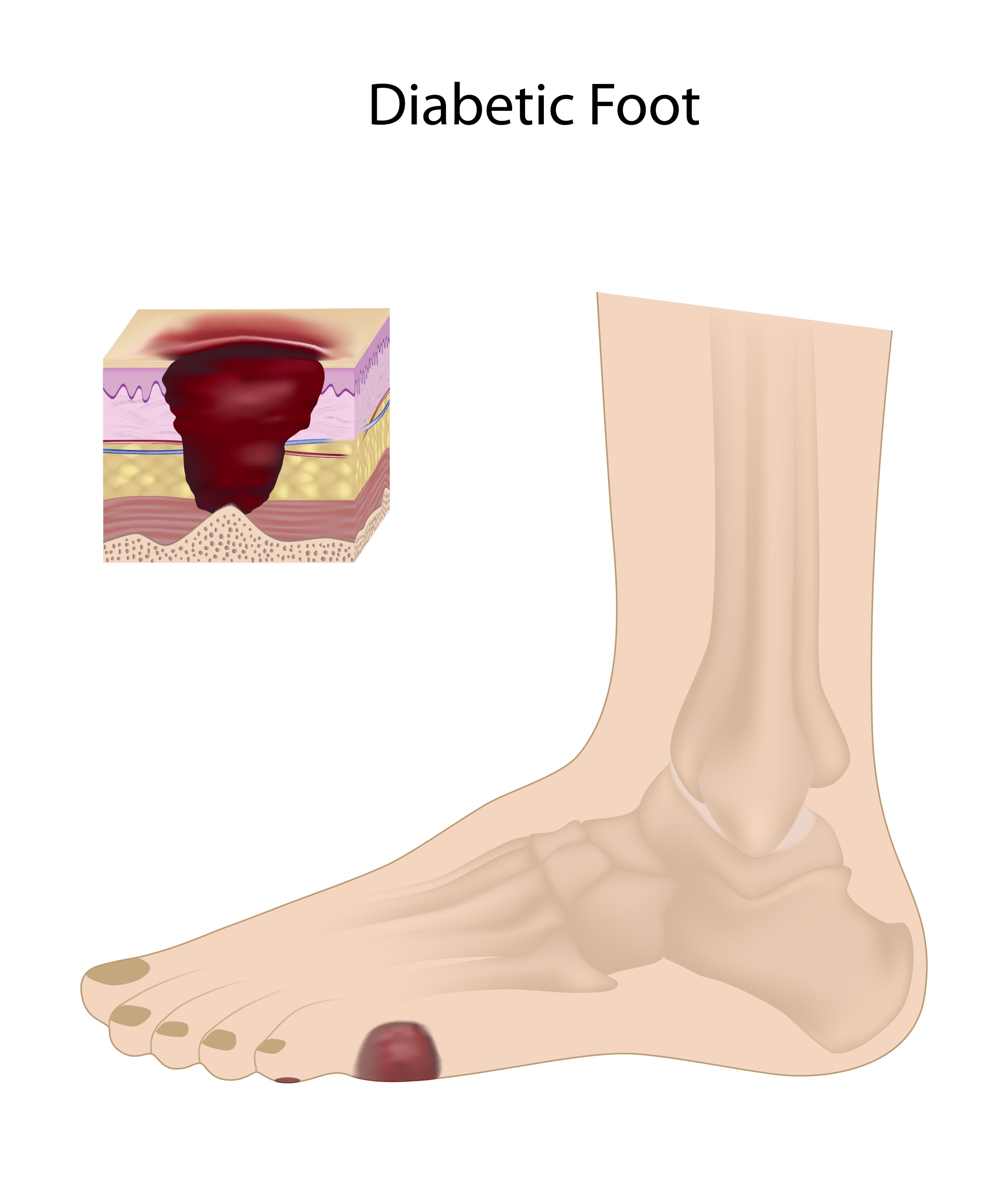 Are Diabetics More Prone To Suffering From Toenail Fungus? Clinic