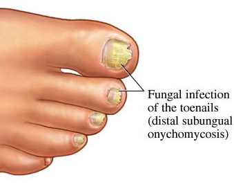 Houston Toenail Fungus: Infected Toenail Treatment l Clear Toes