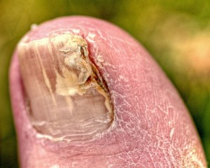 Get rid of toenail fungus to ensure that you don't get gangrene