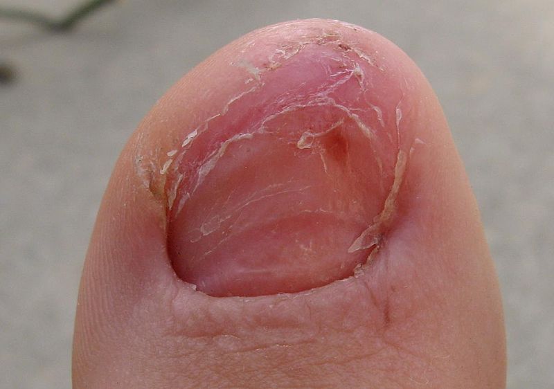 Pictures Of Toenail Fungus Is This What You Have